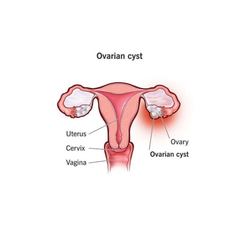 Ovarian cysts cause and dignose 